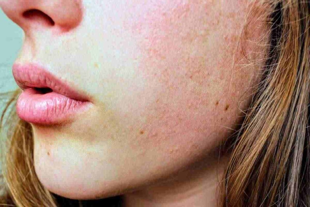 Non sottovalutare i puntini bianchi sulle labbra, tutti i dettagli
